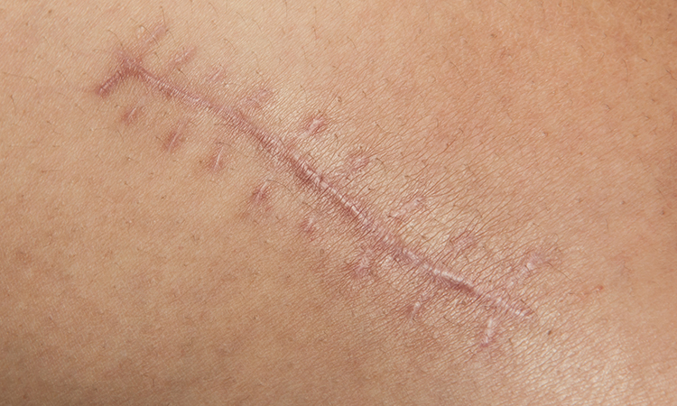Understanding Scar Tissue & How to Help Healing